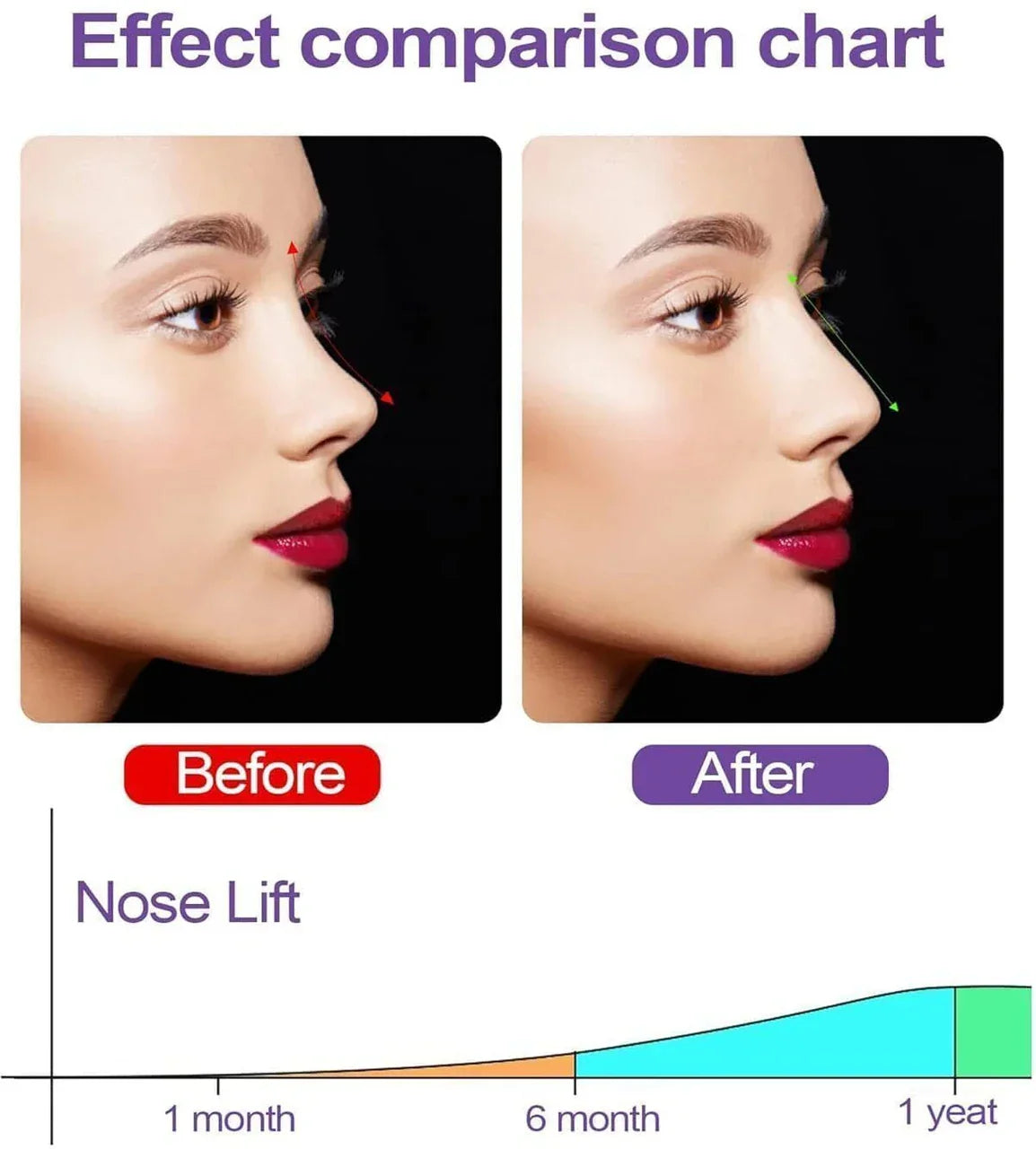 Silicone Nose Corrector Device for Lifting